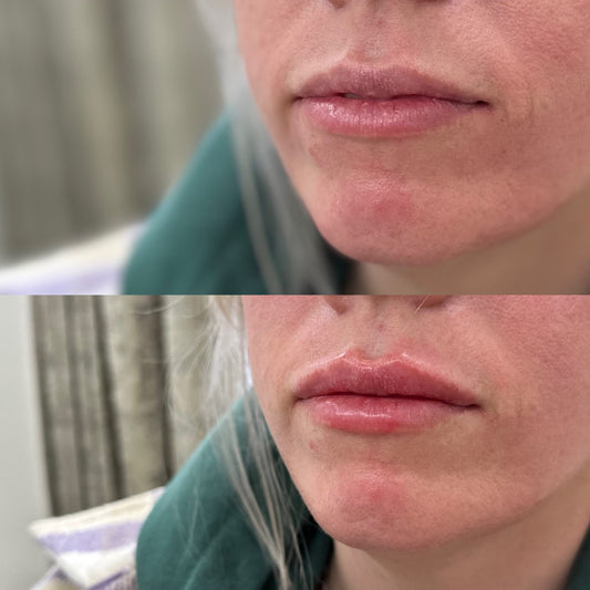 Lip filler  (1/2 syringe or full) get a free koochi product